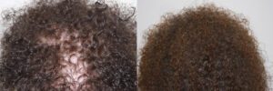 womens-hair-restoration-1