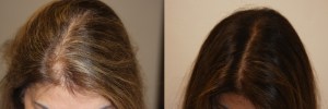 womens-hair-restoration-10 (1)