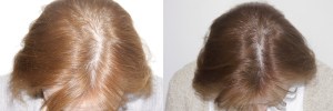 womens-hair-restoration-12 (1)