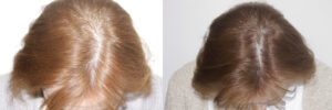 womens-hair-restoration-12