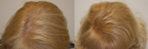 womens-hair-restoration-4 (1)