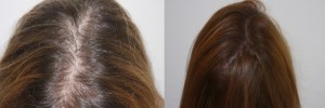 womens-hair-restoration-5 (1)