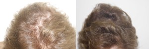 womens-hair-restoration-6 (1)
