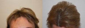 womens-hair-restoration-8 (1)