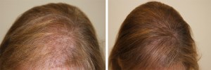 womens-hair-restoration-9 (1)
