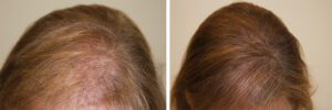 womens-hair-restoration-9